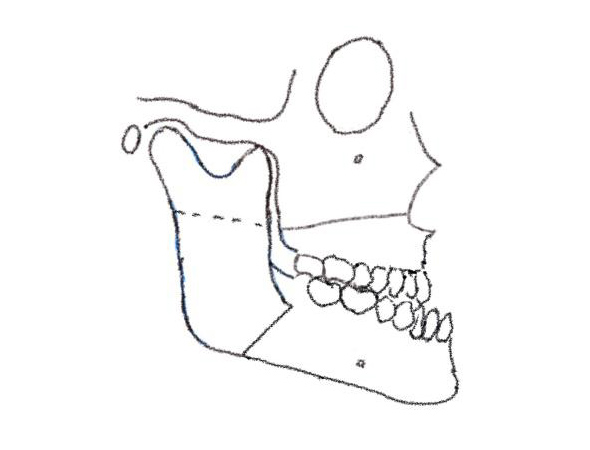 Le Fort I osteotomy (L-1)