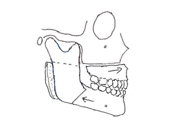 Le Fort I osteotomy (L-1)