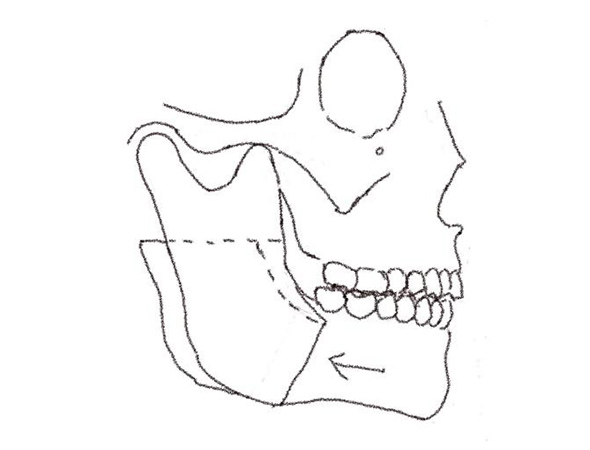 Sagittal Split Ramus Osteotomy (SSRO)