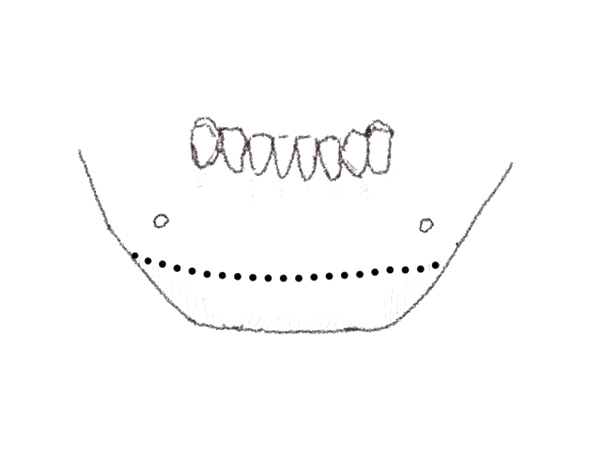 Genioplasty (Chin)