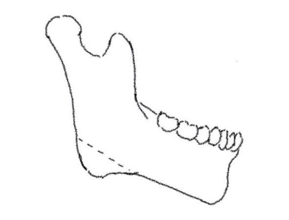 Mandibular Angle Osteotomy