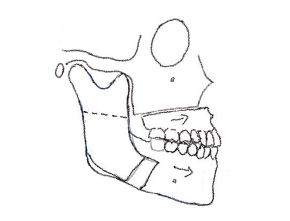 Maxillo-mandibular advancement (MMA)