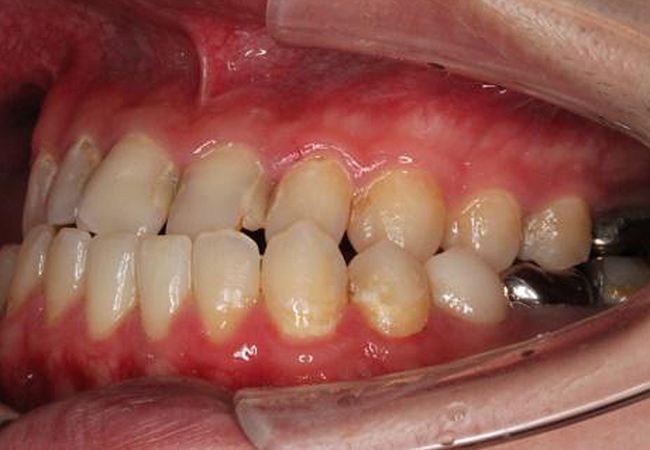 Protruding Jaw (Jaw excess)