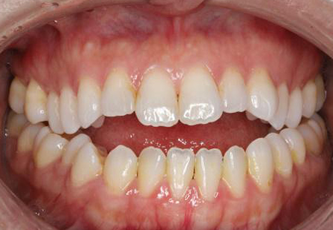 Open bite