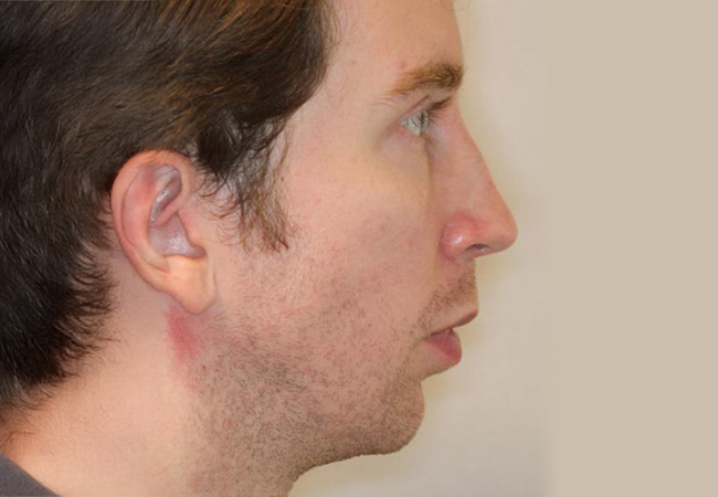 Retrognathia (receding chin)