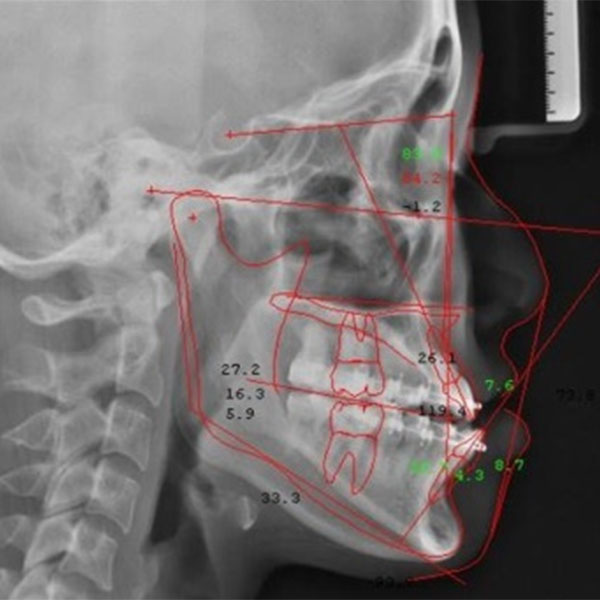 Typical Type of Jaw Deformities
